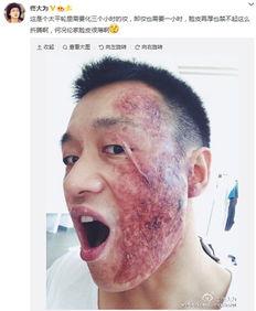 脸伤疤图片,探寻脸伤疤背后的故事